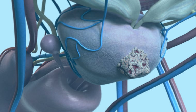 Medical illustration of prostate cancer cells in the prostate gland.