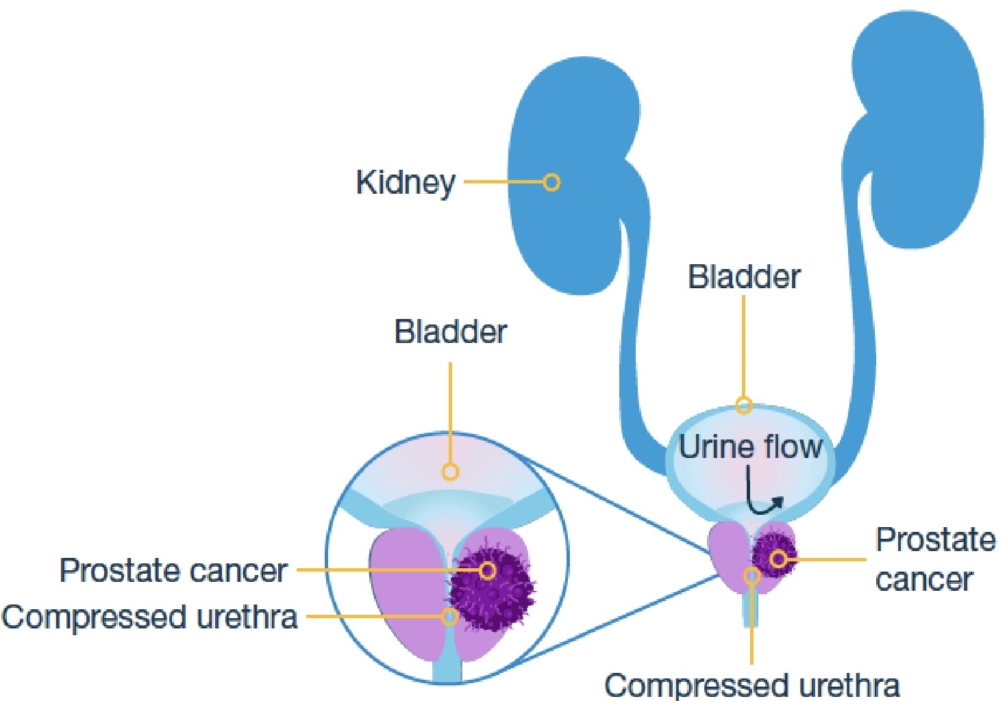 Diagram showing how prostate cancer causes a compressed urethra and restricted urine flow.